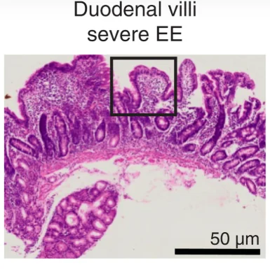 Publication figure for Single-cell profiling of environmental enteropathy reveals signatures of epithelial remodeling and immune activation